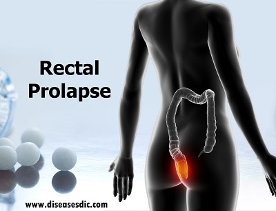 Rectal Prolapse