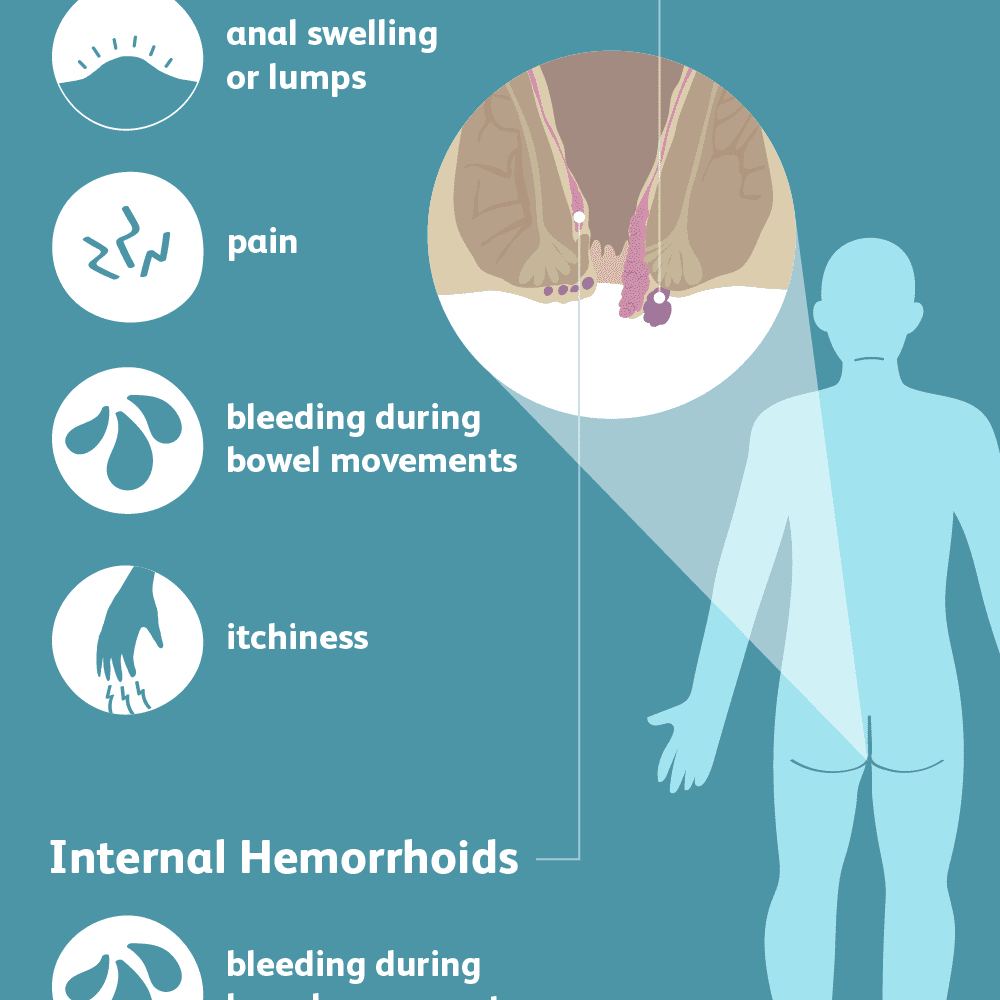 hemorrhoids symptoms
