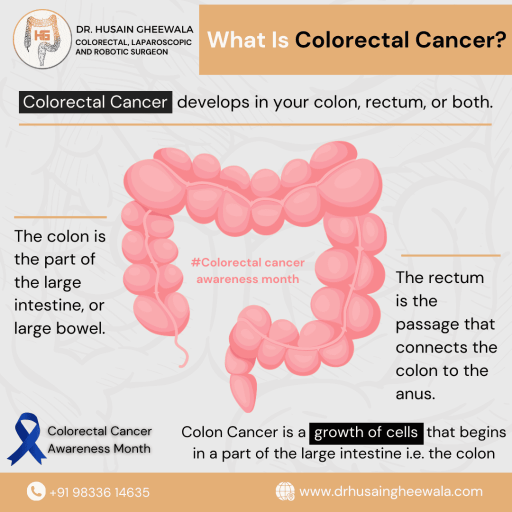 What Is Colorectal Cancer