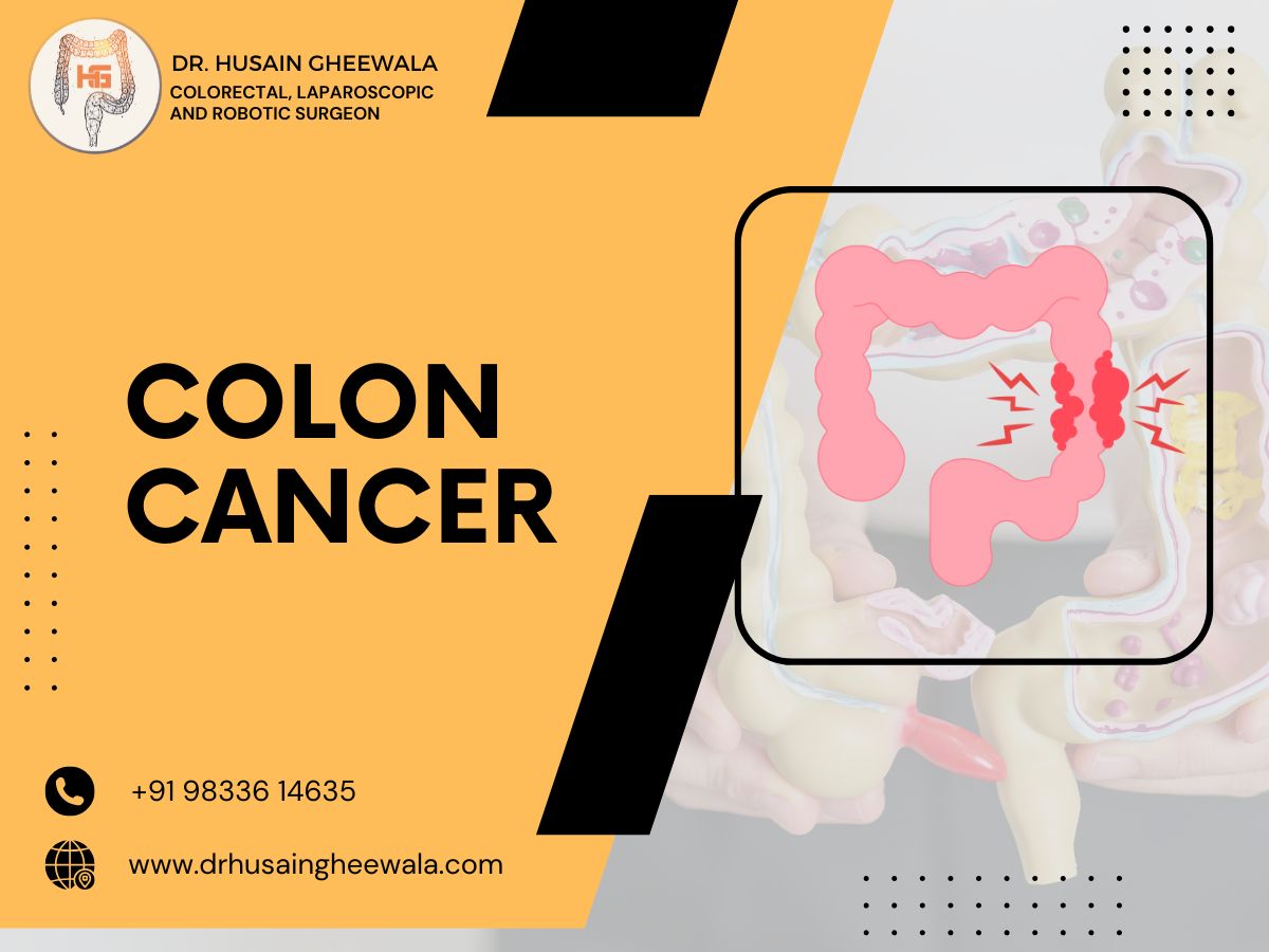 Infographic on colon cancer awareness by Dr. Husain Gheewala, colorectal surgeon. Contact info and website included.