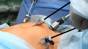 Laparoscopic surgery in progress, showing medical instruments inserted into a patient's abdomen in a sterile environment.