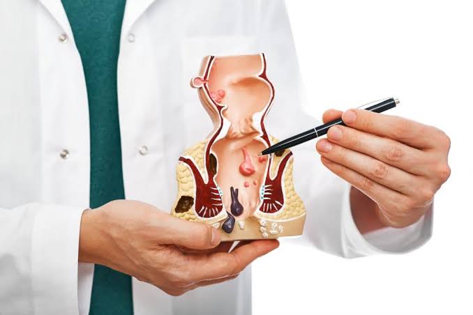 When Should You See a Proctologist? 1 Doctor pointing at anatomical rectal model, illustrating hemorrhoid condition.